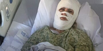Georgia Woman Hospitalised with Third-Degree Burns After Chemical Attack