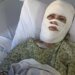 Georgia Woman Hospitalised with Third-Degree Burns After Chemical Attack